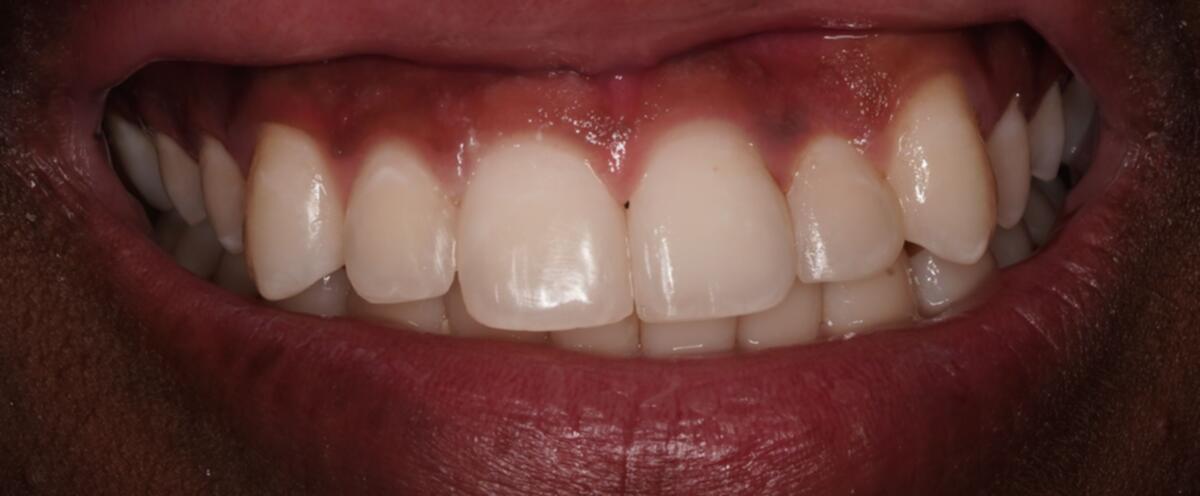After composite bonding treatment on front teeth