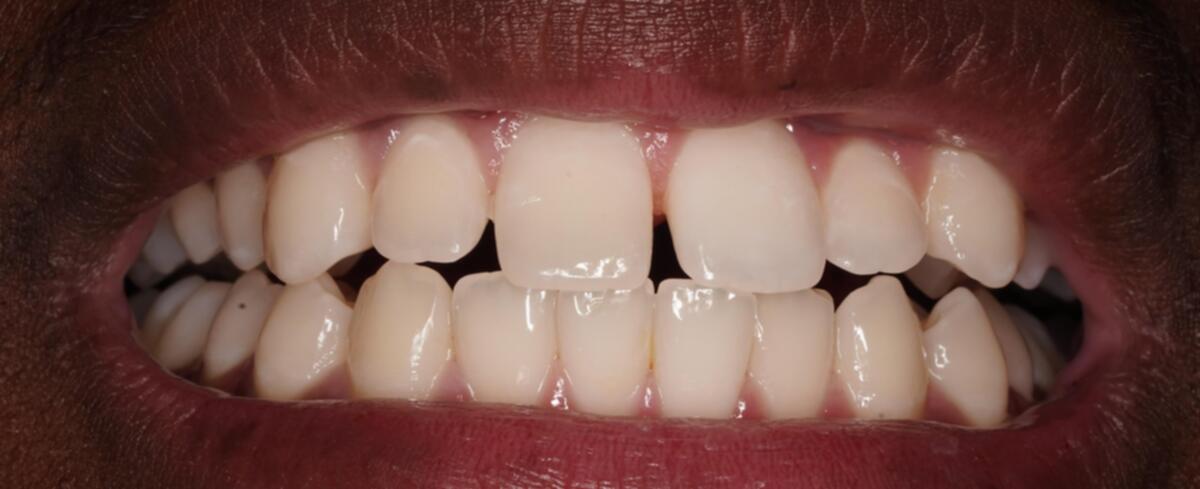 Before composite bonding treatment on front teeth