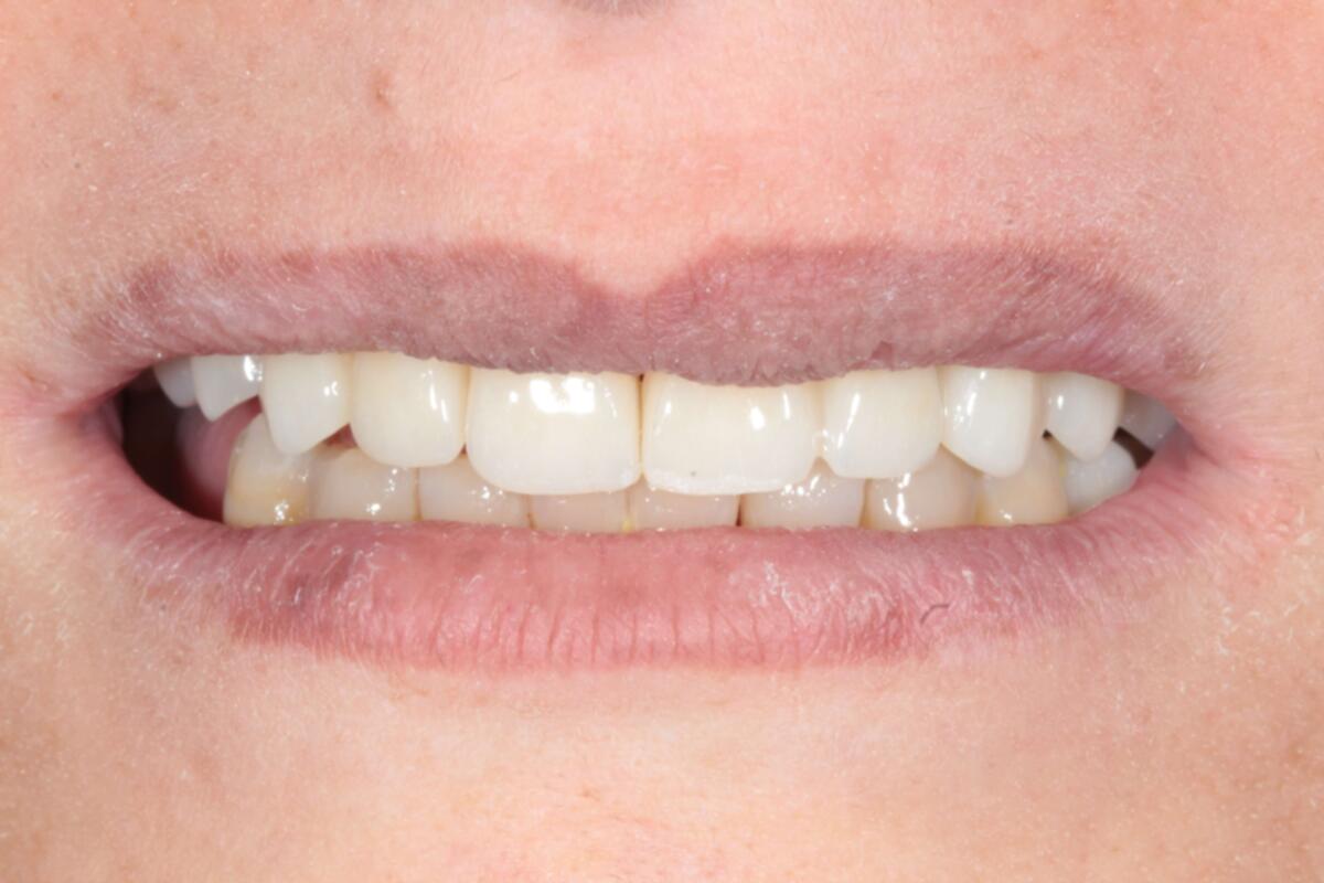After porcelain veneers treatment