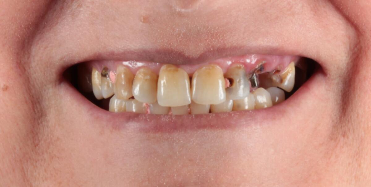 Before porcelain veneers treatment